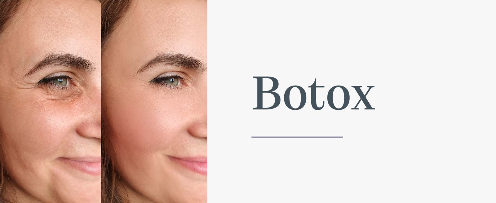 Botox Treatments